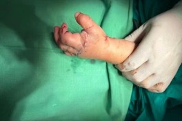 3 yaşlı uşağın ət maşınında ağır yaralanan əli 8 saatlıq mikrocərrahi əməliyyatla bərpa edilib - FOTO
