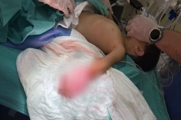 3 yaşlı uşağın ət maşınında ağır yaralanan əli 8 saatlıq mikrocərrahi əməliyyatla bərpa edilib - FOTO